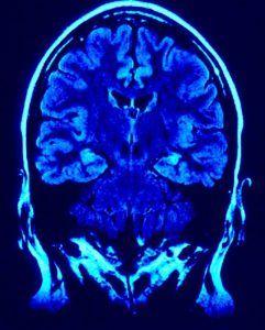 Brain Trauma injury