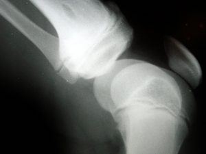 Knee Injuries