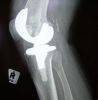 Joint Injuries 
